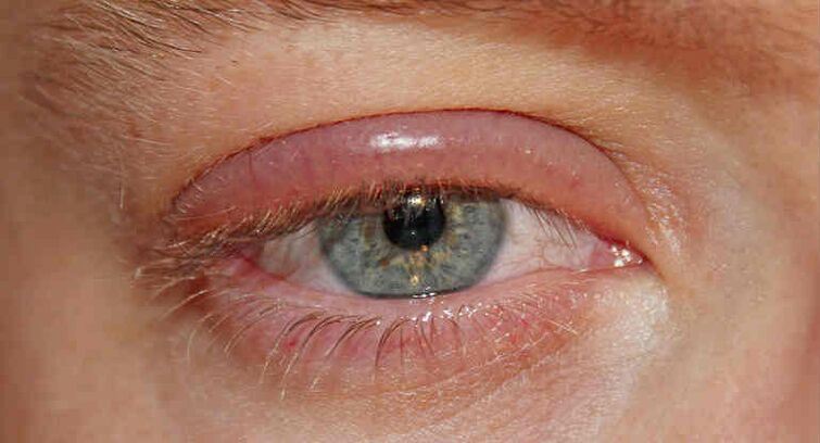 Demdectic scab on the eyelids